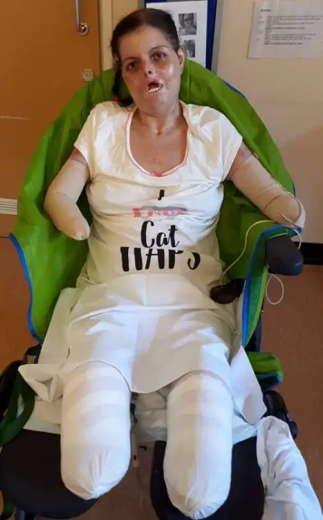 Susan Neil in her wheelchair in hospital with all four limbs amputated and with bandages on her legs