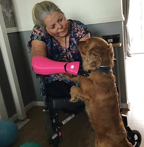 Susan Neil in her wheelchair with a pink Open Bionics prosthetic arm hugging and stroking her dog