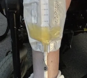 Emma's suprapubic catheter leg bag with urine